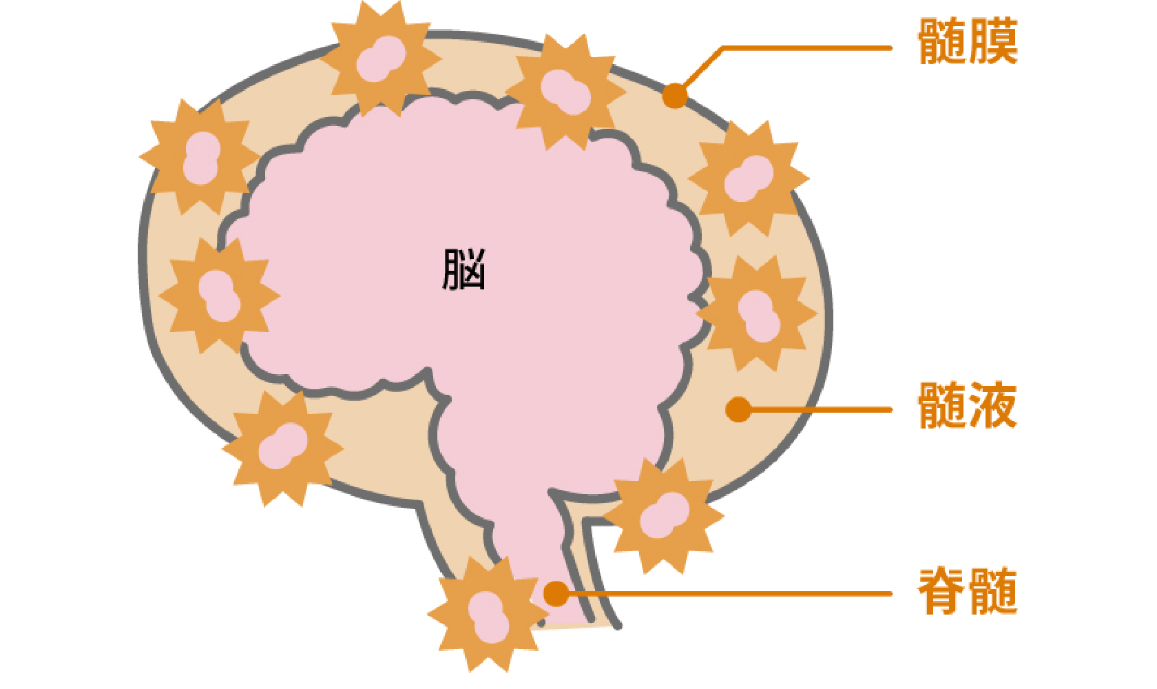 細菌性髄膜炎の主な原因は、肺炎球菌とヒブです