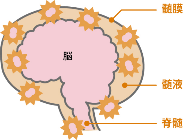 細菌性髄膜炎の主な原因は、肺炎球菌とヒブです